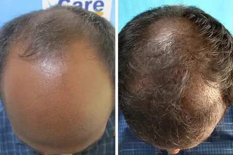 Hair rejuvation therapy before photo in VCare